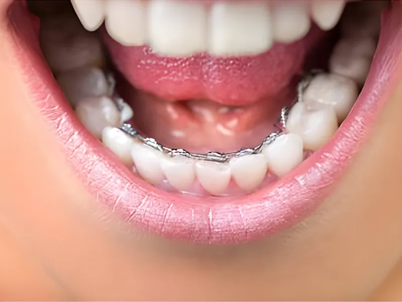 Lingual Ortodonti Nedir?