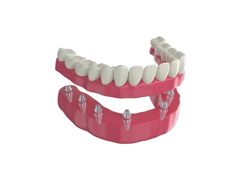 All-On-Four İmplant Tedavisi
