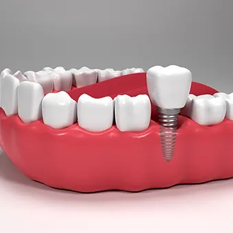 Diş İmplantlarının Avantajları