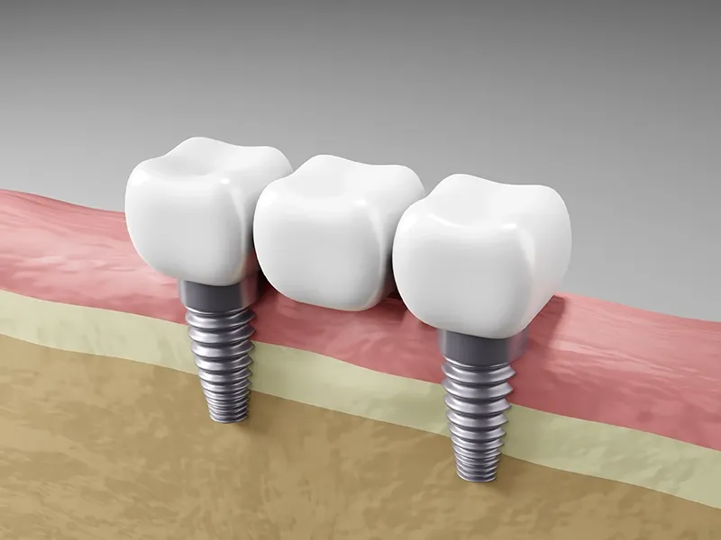 İmplant Destekli Protezler ve Köprüler