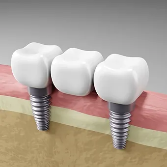 İmplant Destekli Protezler ve Köprüler