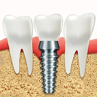İmplantın Diğer Tedavi Alternatifleriyle Karşılaştırılması