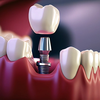 Implant